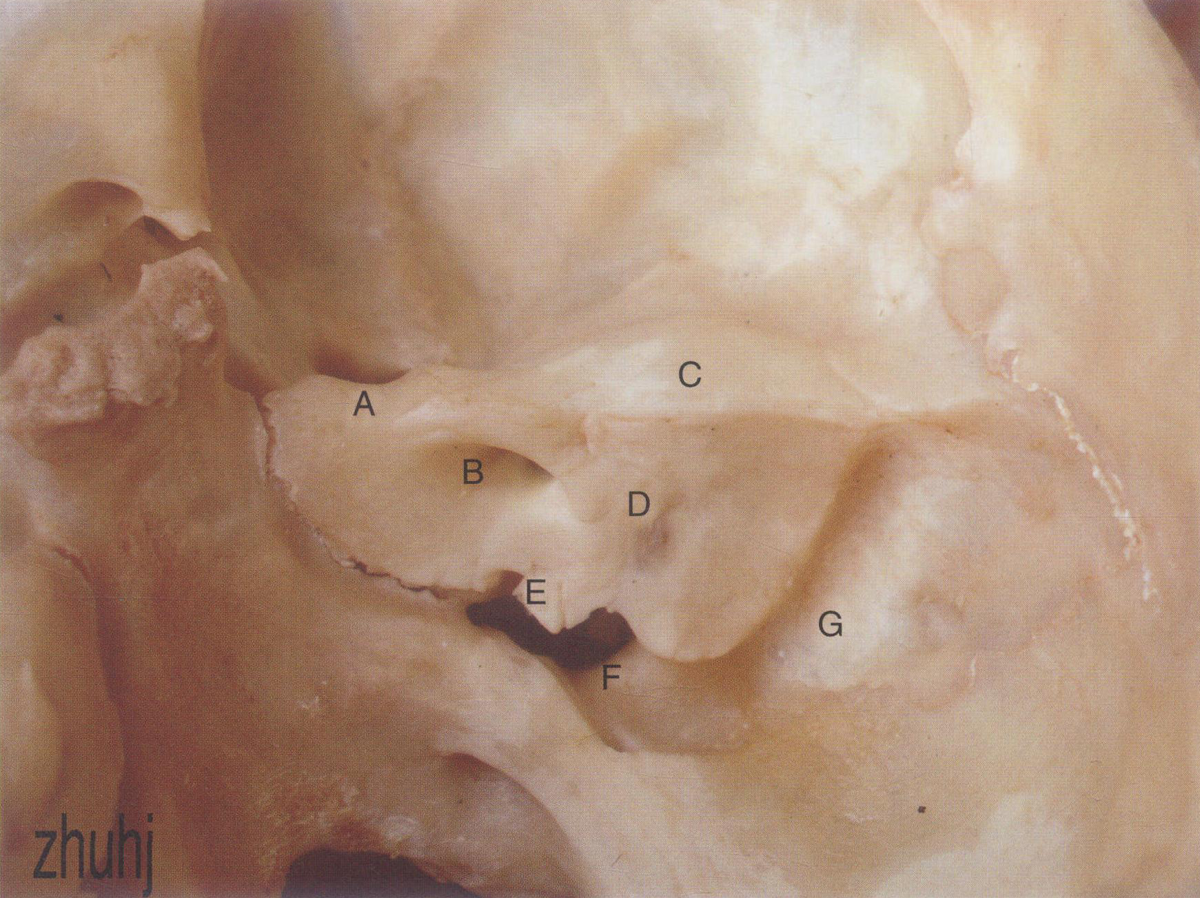 右侧颞骨下面观-颞骨手术解剖学-医学